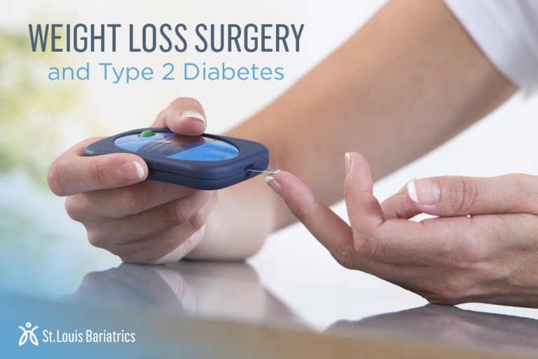 Bariatric Weight Loss Surgery Can Cure for Type 2 Diabetes