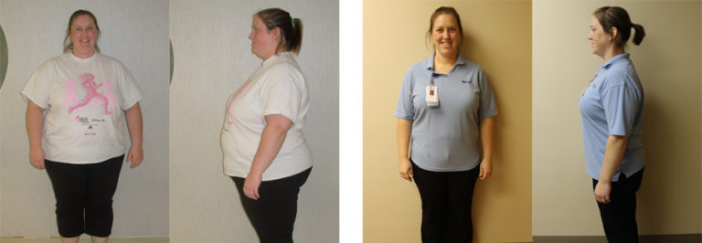 Lisas Gastric Sleeve Transformation St Louis Bariatrics 0433