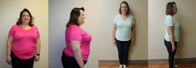 Christines Gastric Sleeve Success St Louis Bariatrics 