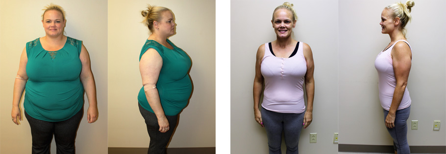 Gastric Sleeve Before And After In St Louis St Louis Bariatrics