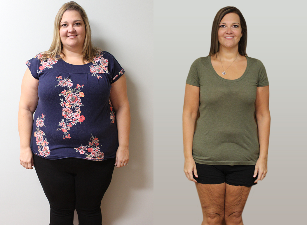 Tracy's Weight Loss Transformation | St Louis Bariatrics