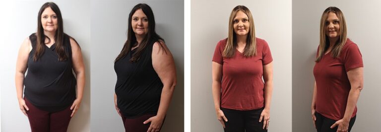 Cynthias Weight Loss Transformation St Louis Bariatrics 